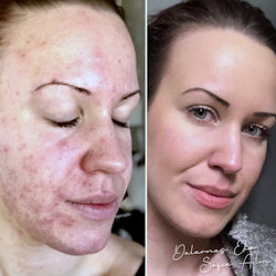 Face oil Acne Treatment