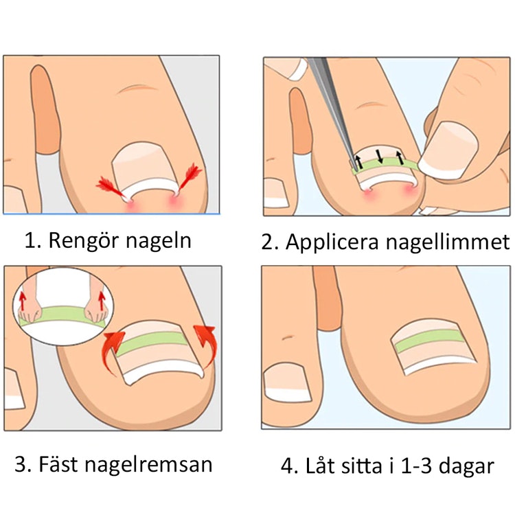 Strimler til nedgroede tånegle