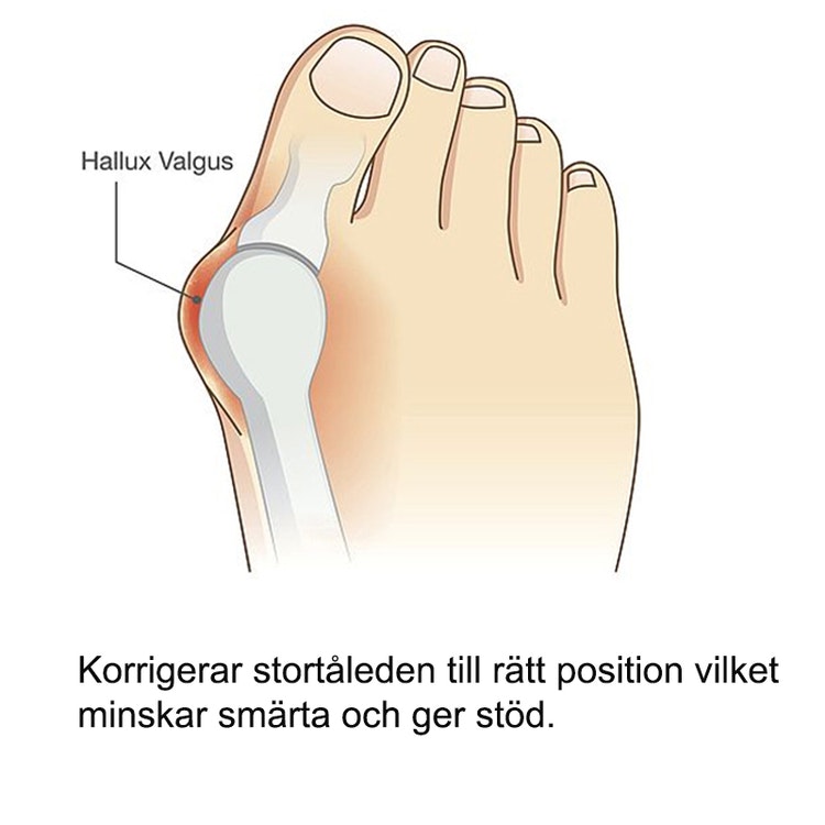 Hallux valgus natskinne