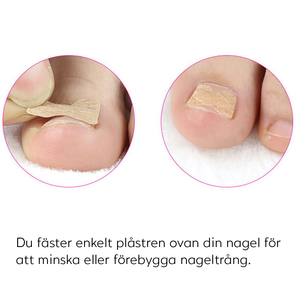 Plaster mod nedgroede negle (10-pak)