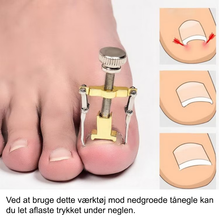 Nedgroede tånegle (skrue)