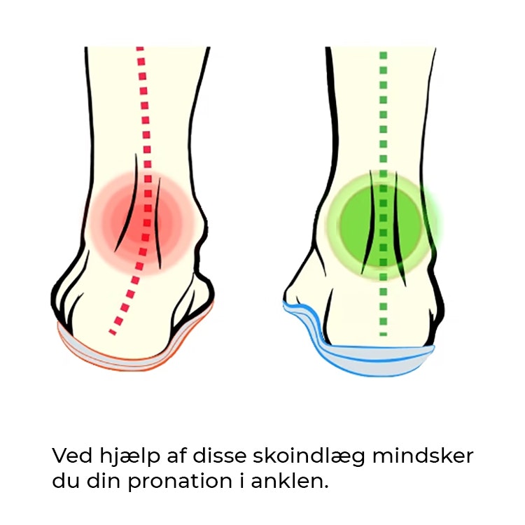 Skoindlæg pronation