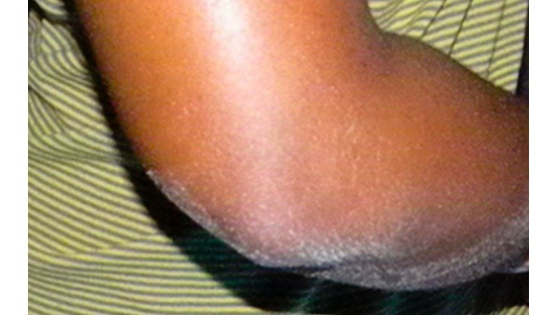Ashy skin vad är det?