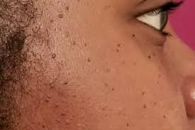 DPN Dermatosis papulosa nigra