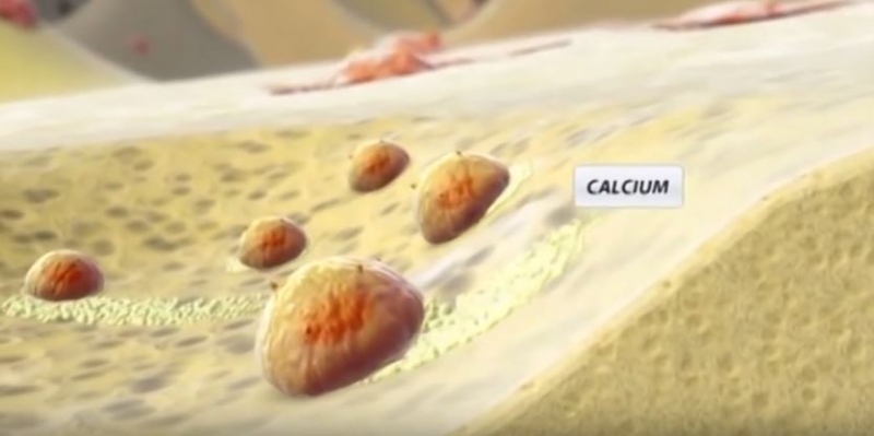 Se hur Kalcium binds till benmassan