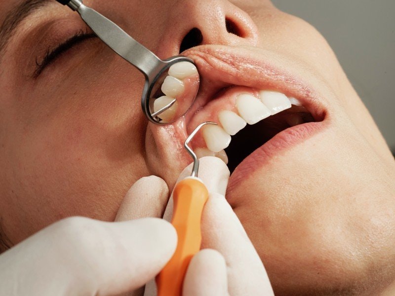 Tandköttsinflammation (gingivit) | Ett vanligt problem