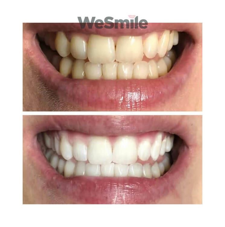 WeSmile Tandblekning startkit
