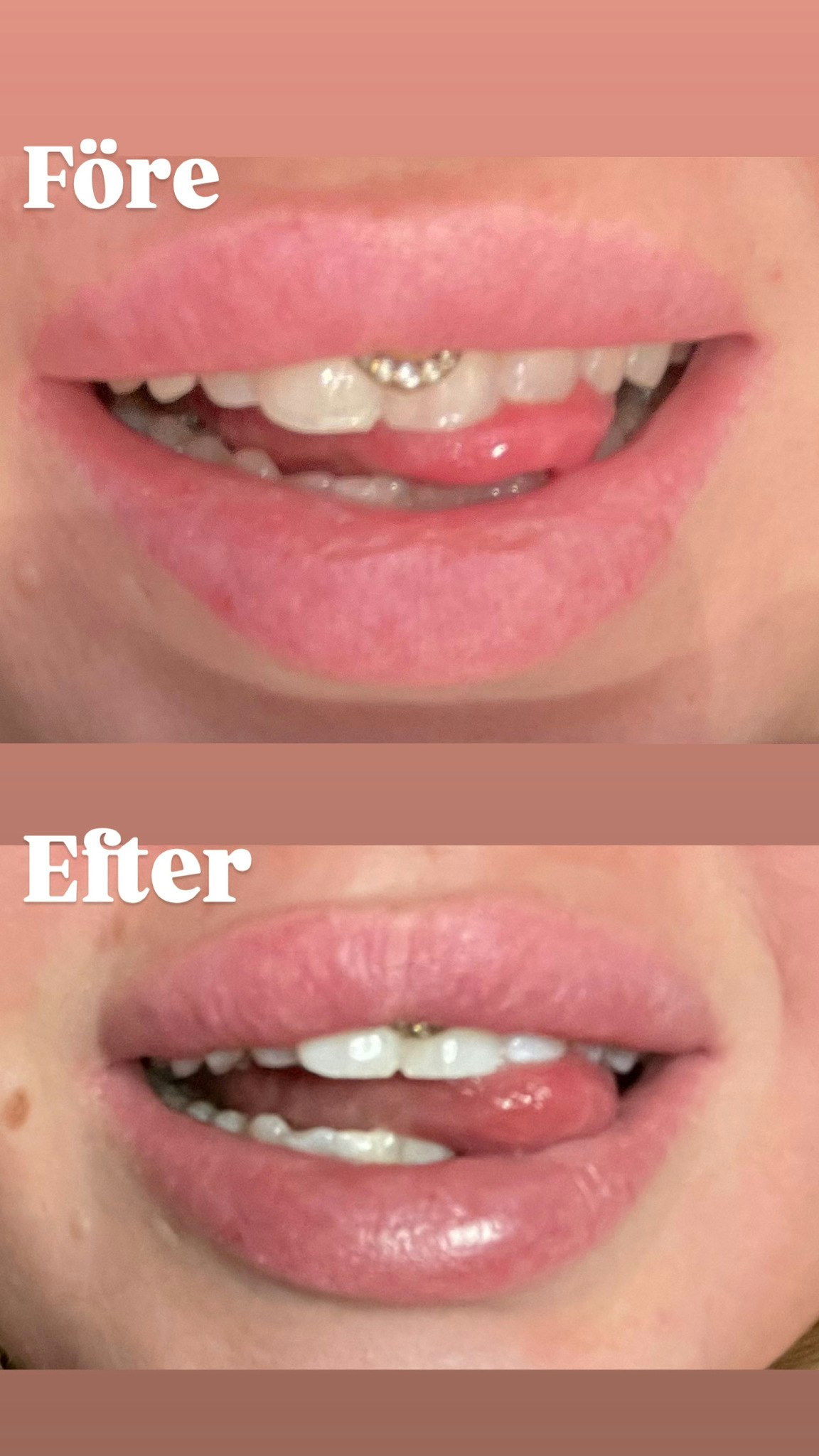 WeSmile Tandblekning startkit