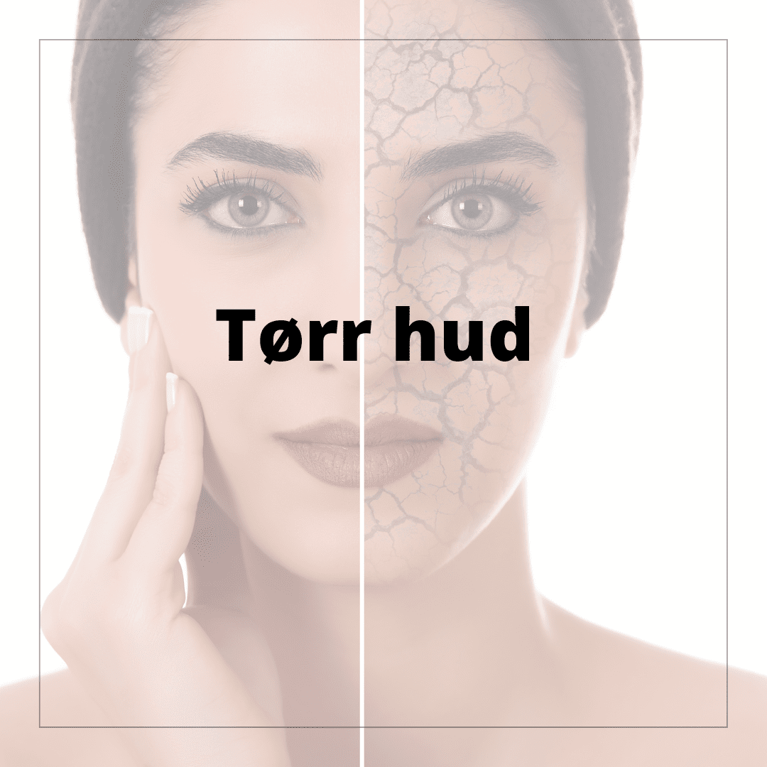 Tørr hud - hudshop.no