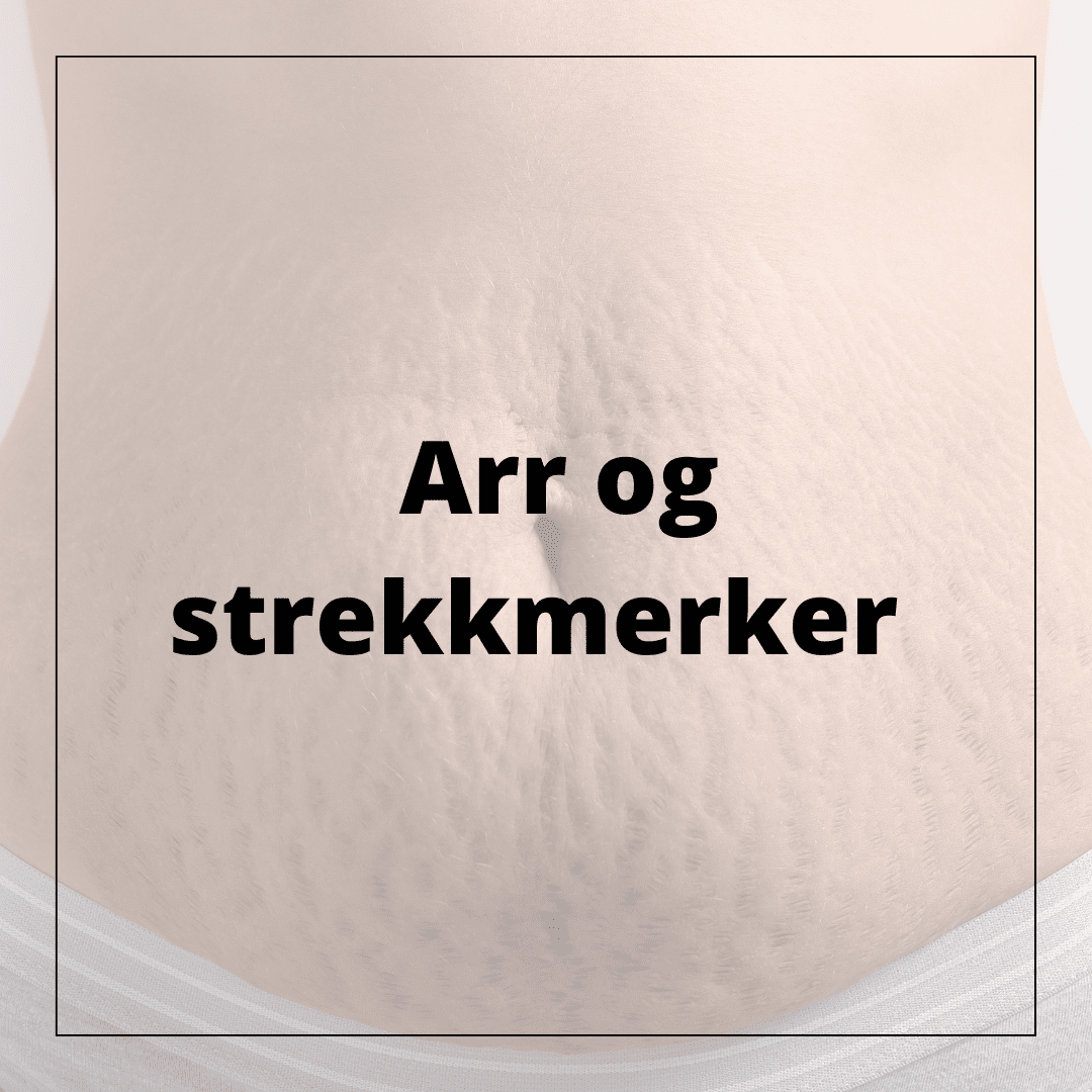 Arr og strekkmerker - hudshop.no 