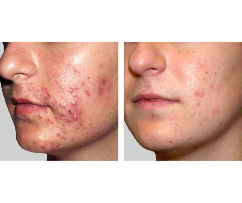 ENVIRON Focus Care Clarity - dema-lac + seb ACE oil (dato 1/25)