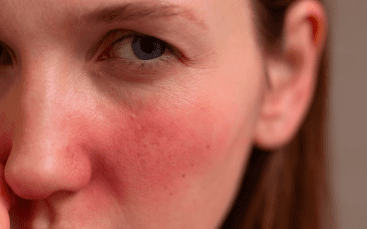 De beste tips for rosacea type 1 og 2