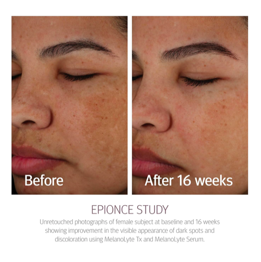 Epionce - MelanoLyte Tx  30ml