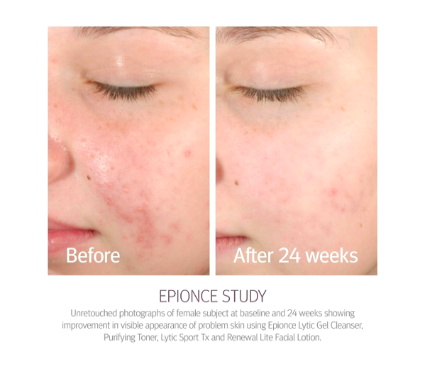 Epionce - Lytic Gel Cleanser 170ml