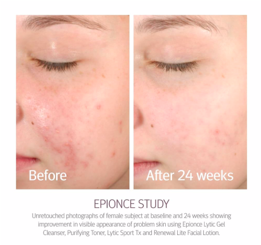 Epionce - Renewal Lite Facial Lotion (combination/ oily skin) 50 ml