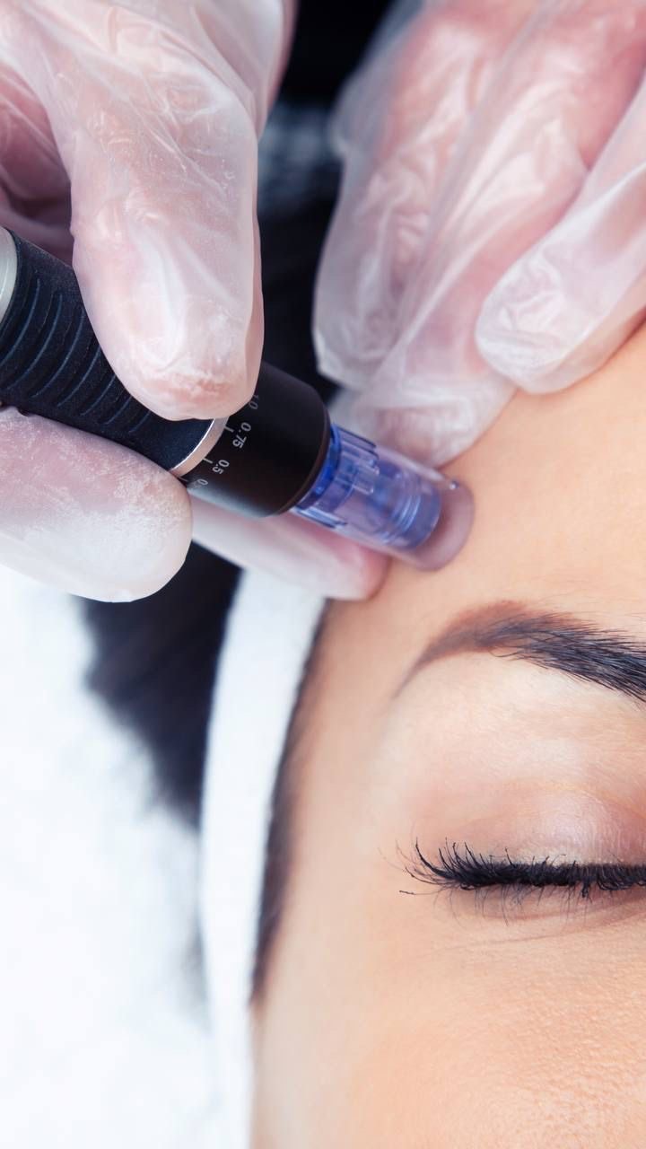 Utbildning Microneedling