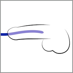 Silikon Dilator Set