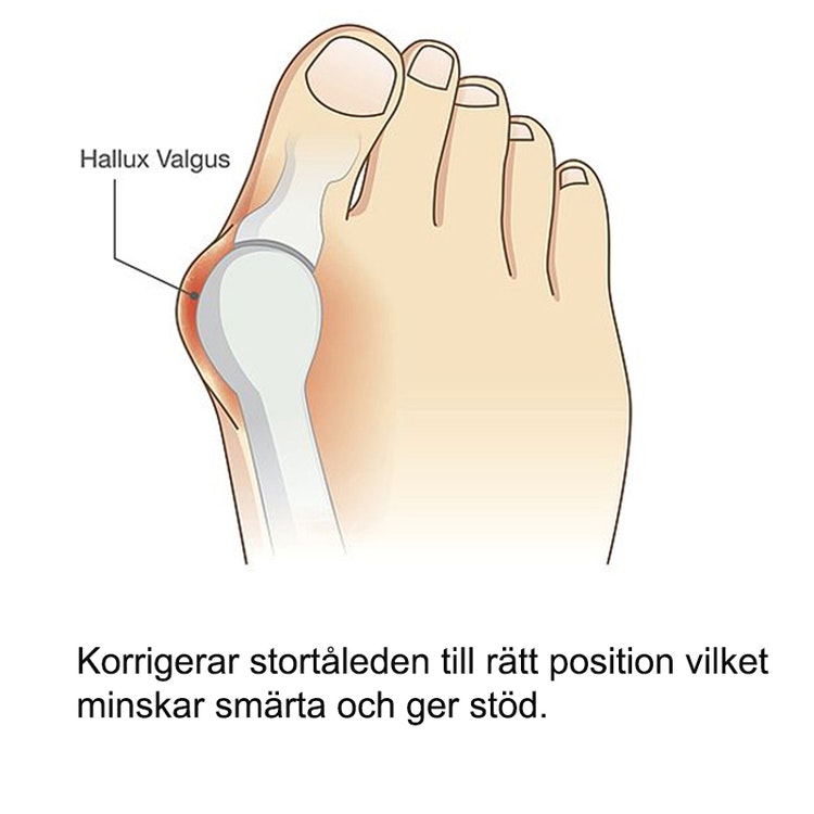 Hallux valgus nachtspalk