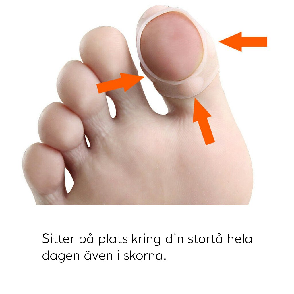 Inåtväxande nagel (Silikonskydd)