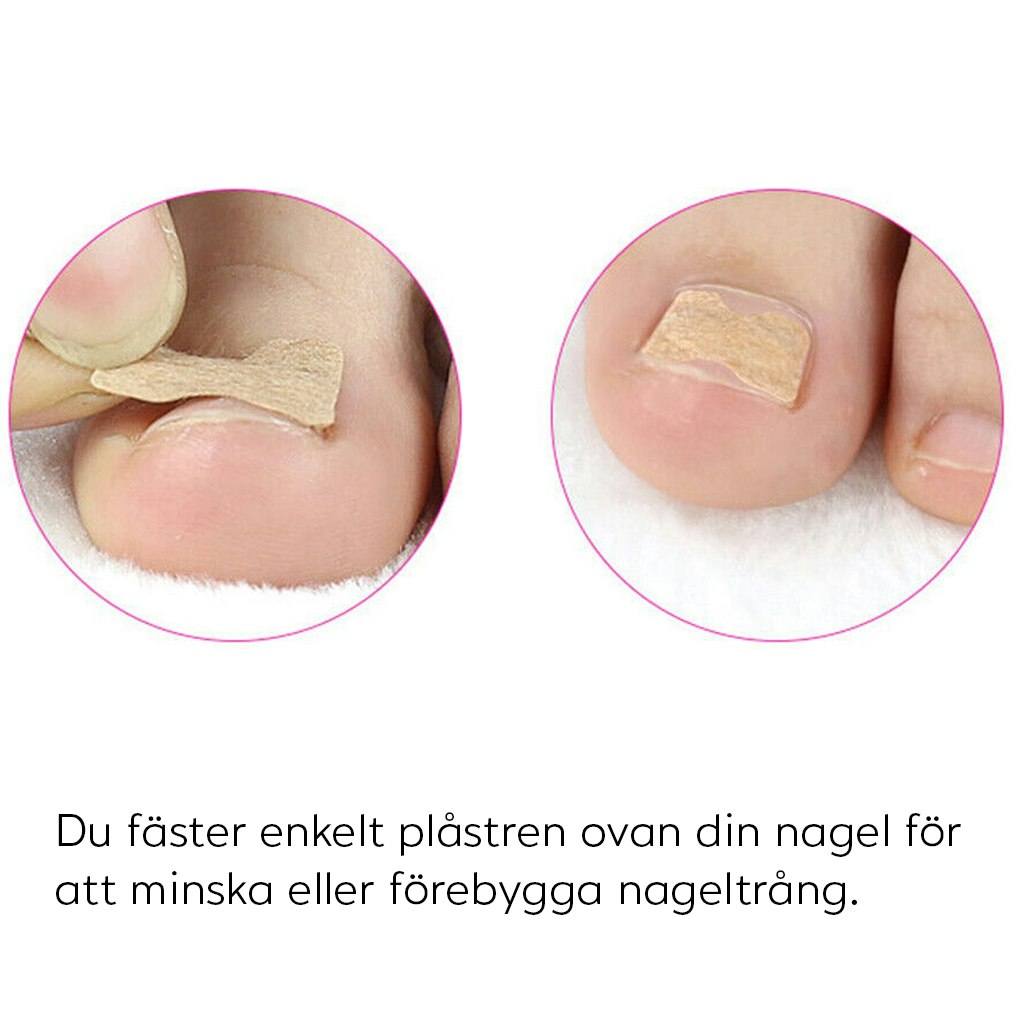 Plåster mot nageltrång (10st)