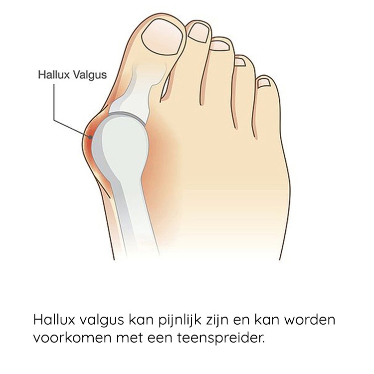 Hallux valgus sok