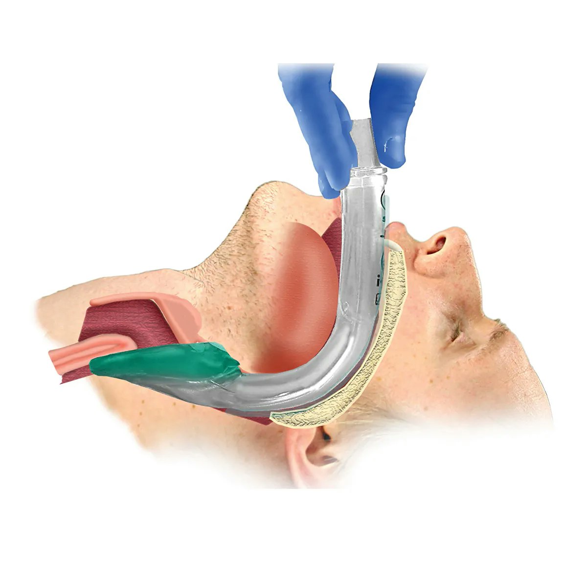 Larynxmaske i-gel kit str 4
