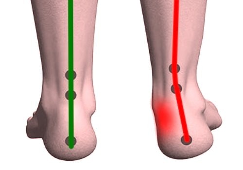 Fotproffsen.se > Pronation