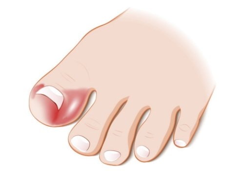 Fotproffsen.se > Nageltrång
