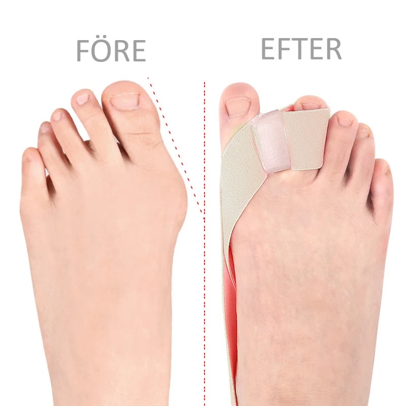 Hallux Valgus korrigerande band med tåseparerare BEIGE