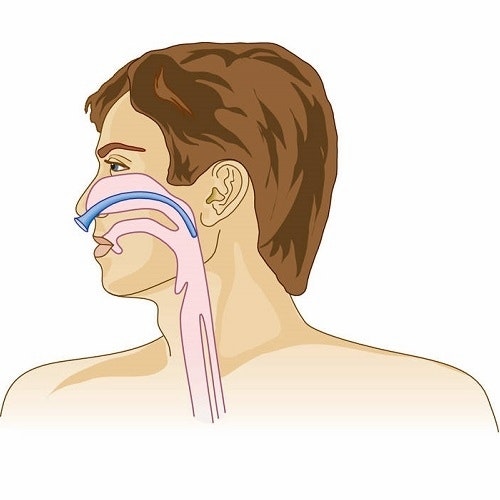 Nasopharyngeal Airway/ Nästub