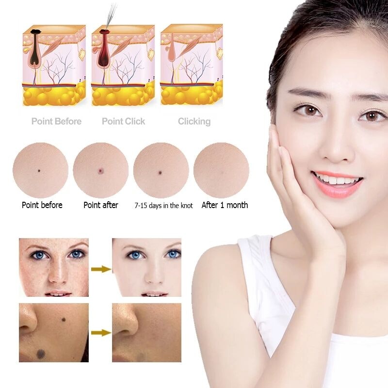 Skin Mole Removal Pen