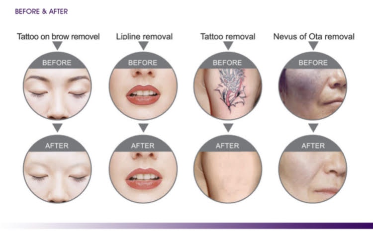 Karbon peeling kurs + tattoo bortagning