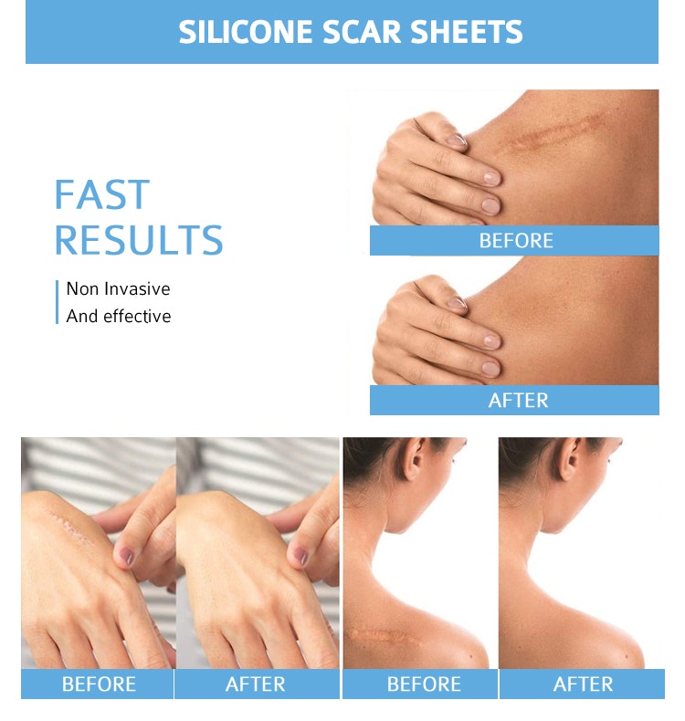 Silikon Scar Sheets