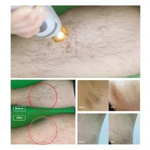 Alexandrite Nd Yag laser hårborttagningsmaskin