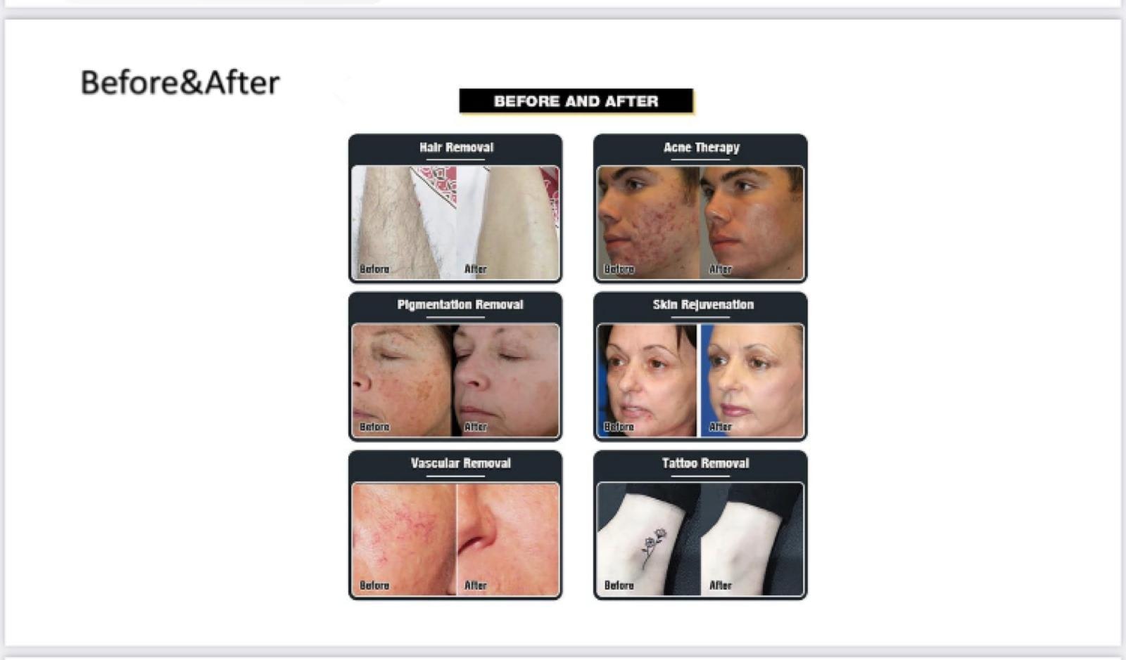 3 in one multifunction laser maskine
