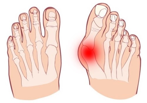 Hallux valgus - Rehab Prylar