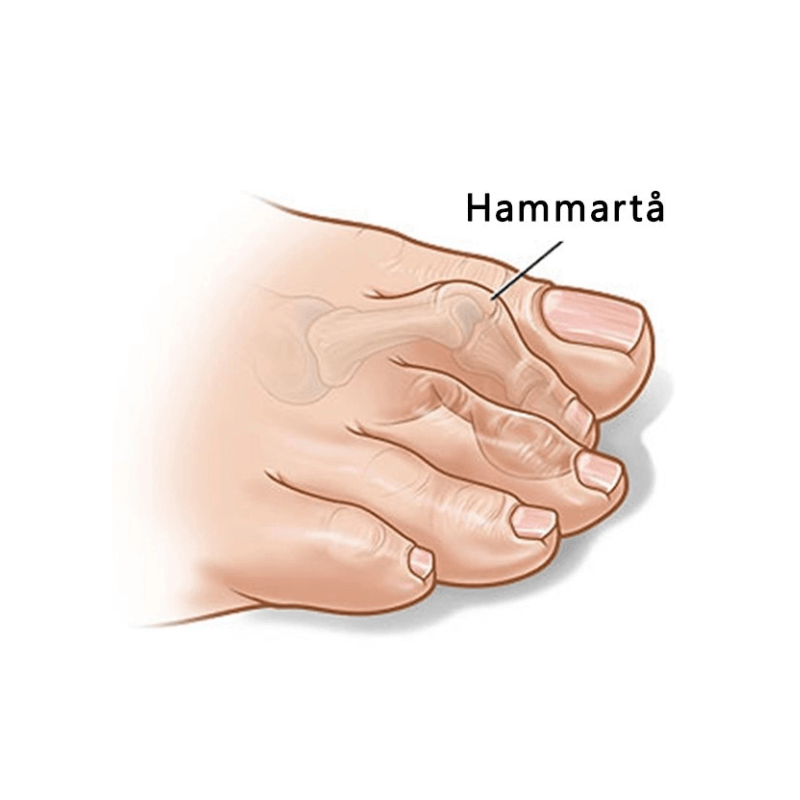 Tåspridare för Hammartå och Hallux valgus (2st)