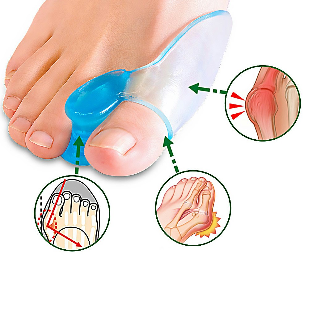 Tå separerare - Korrigerar sneda tår och förebygger hallux valgus
