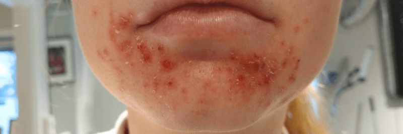 Perioral Dermatitt: En Irriterende Hudtilstand
