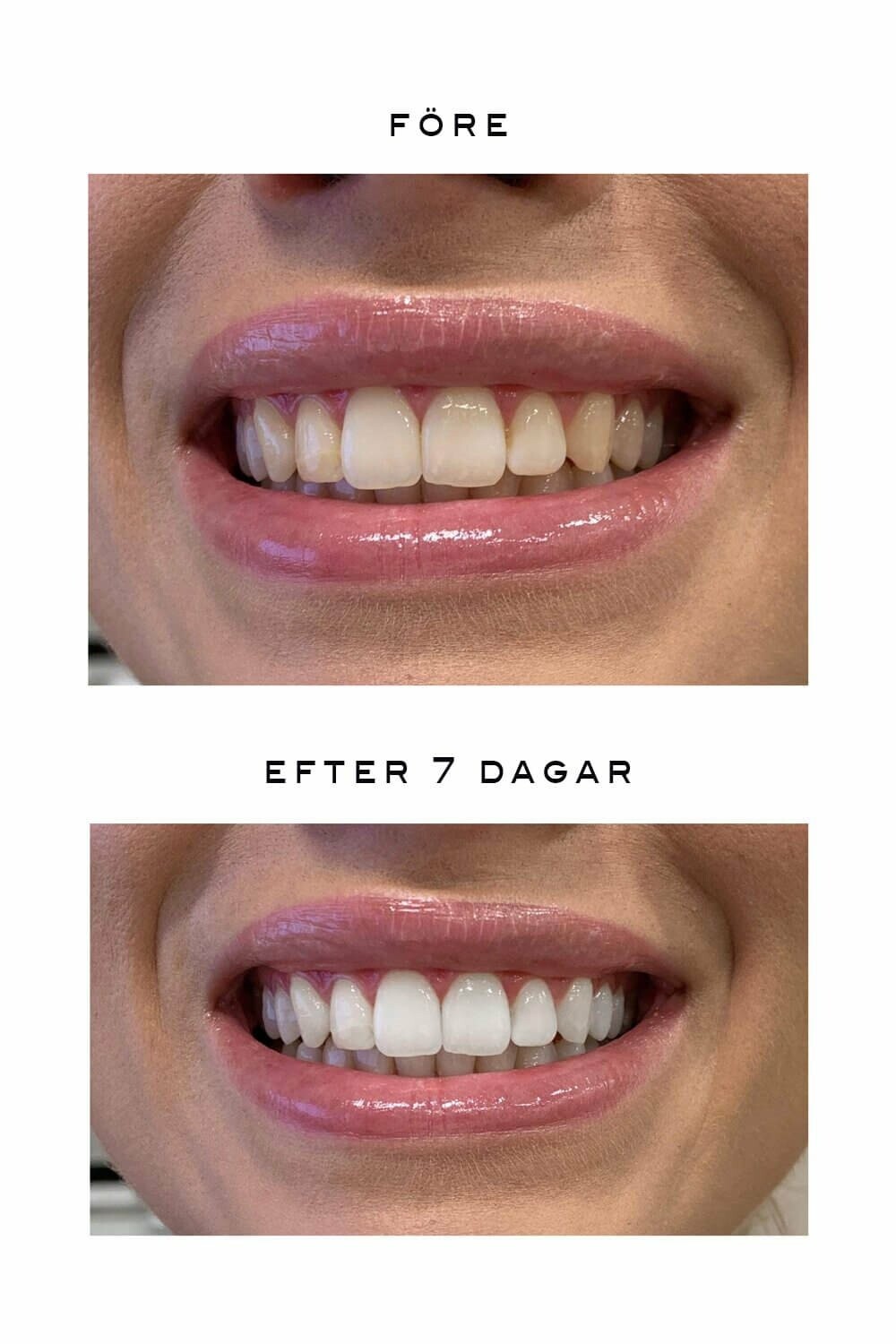 DM Teeth Whitening 30 g