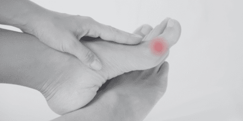 Hallux Valgus – Orsaker, Symtom och Effektiva Lösningar