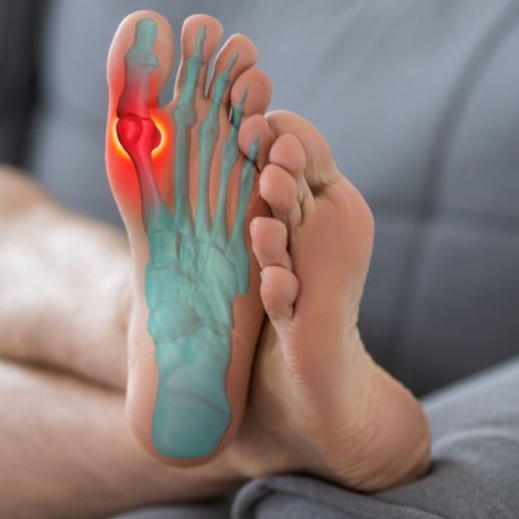 Einlegesohlen (Hallux rigidus)