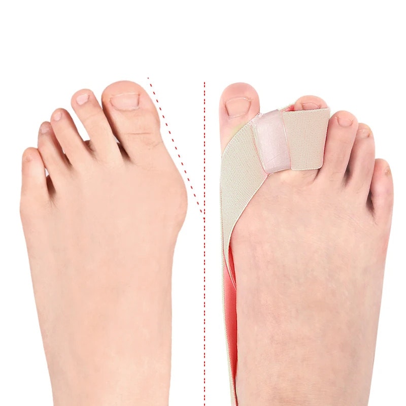 Hallux Valgus korjausnauha varpaiden erottimella BEIGE