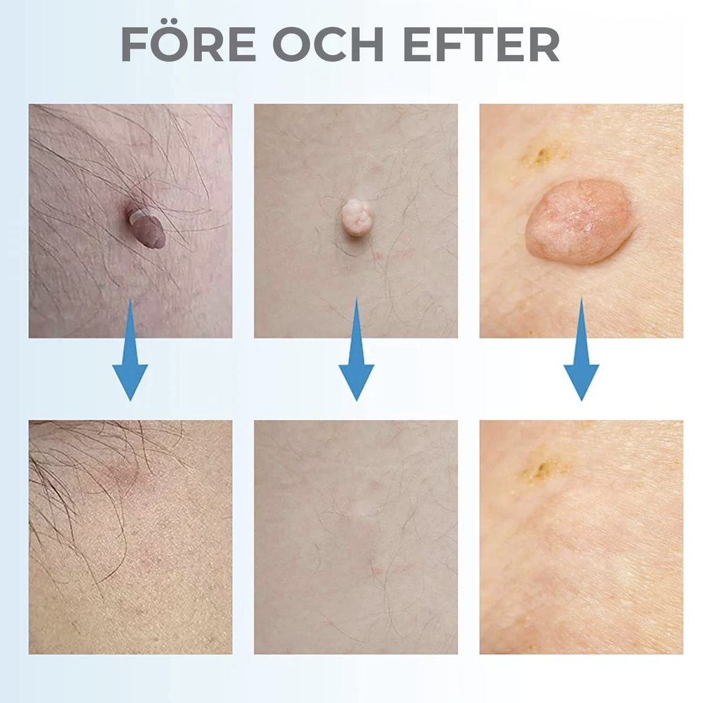 Ta bort hudflikar och födelsemärken hemma – enkelt och naturligt