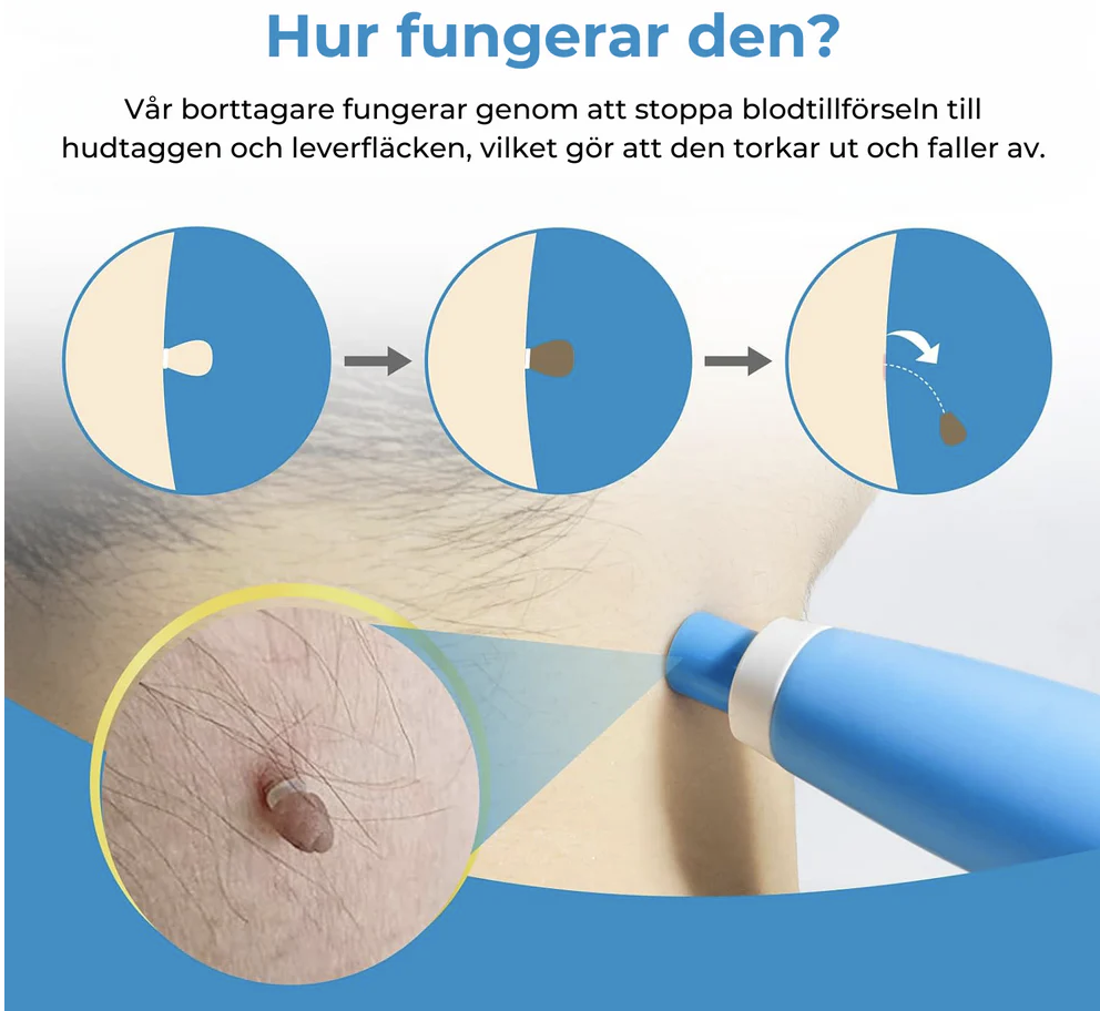 Ta bort hudflikar och födelsemärken hemma – enkelt och naturligt