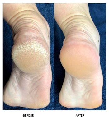 Lova Skin Instant Foot Peeling Kit